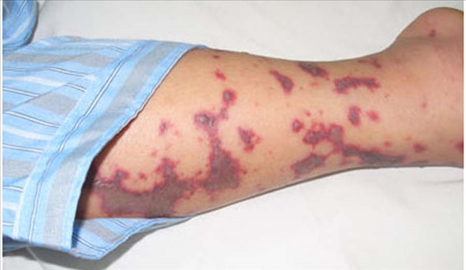 SEPSİS´İ TANI, HAYATI KURTAR - video