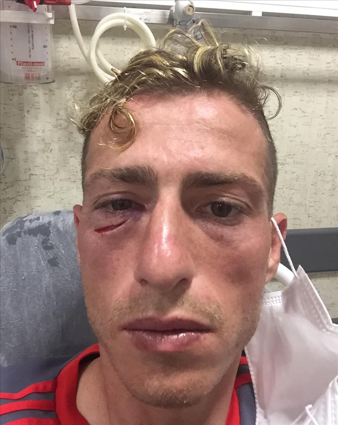 HAKAN´IN YÜZÜ YARILDI