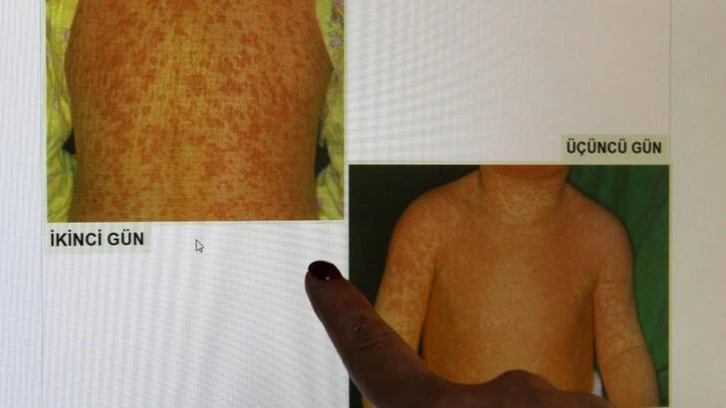 Kızamık Vakalarında Artış Yaşanıyor