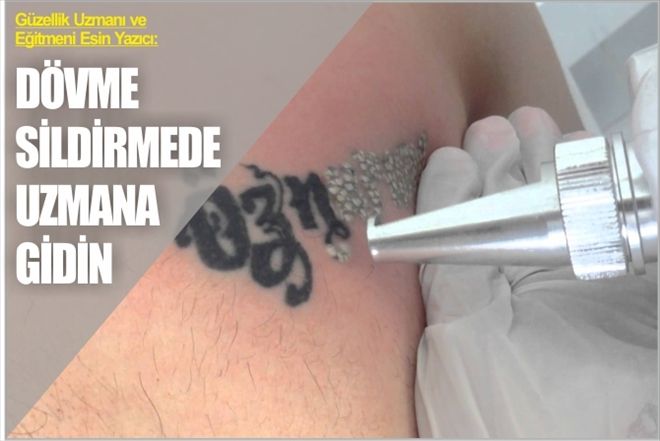 ?DÖVME SİLDİRMEDE UZMANA GİDİN?