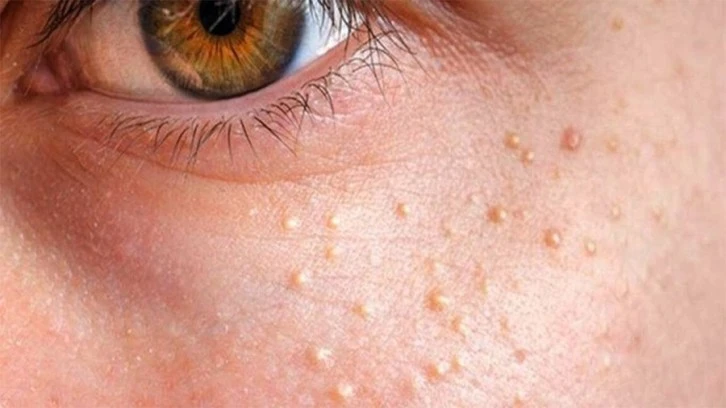 Yağ Bezeleri Kanser Değildir