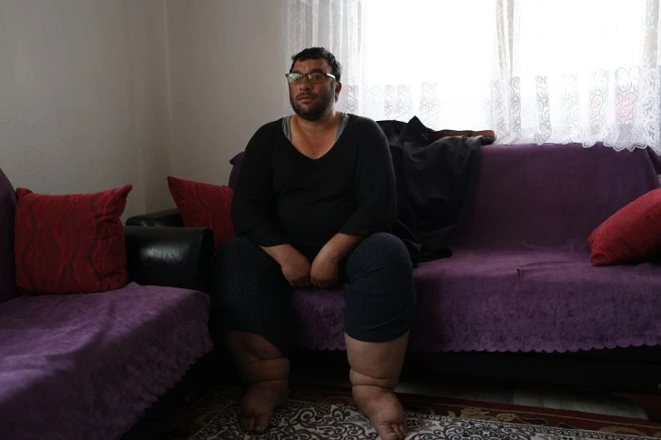 Sivas'ta 25 Yıldır Hastalıkla Mücadele Ediyor, Bacakları 80 Santimetreye Ulaştı