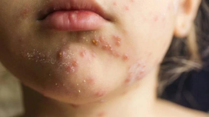 Kızamığa Karşı Aşı Olunmalı