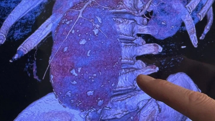 Aort Damarı Patlayan Hasta Sağlığına Kavuşturuldu