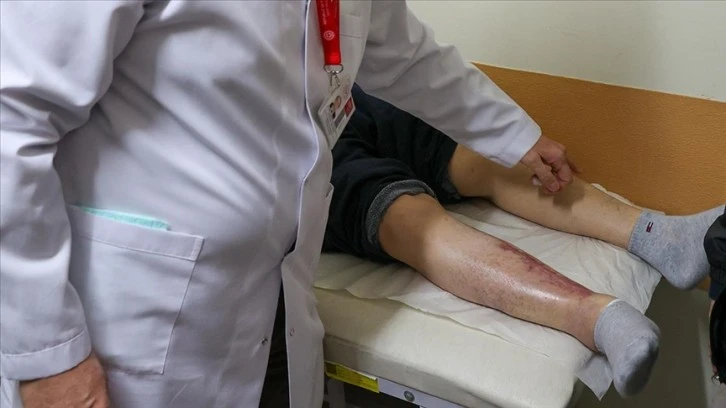 Yaralarından Kök Hücre Tedavisiyle Kurtuldu