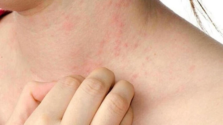 Yaz aylarının en büyük kabusu, hayatı tehdit ediyor