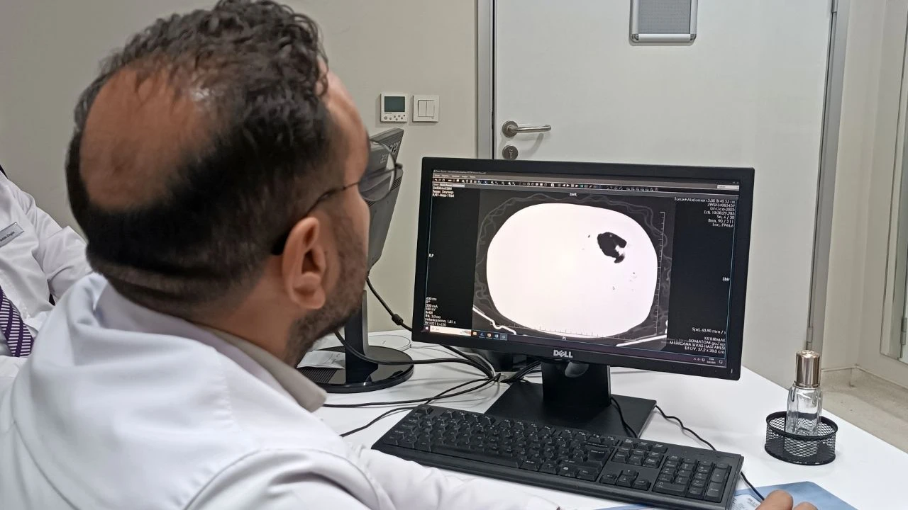 Sivas'ta Uzmanı Açıkladı: "100 Bin Kişiden 200'ü Kanser''