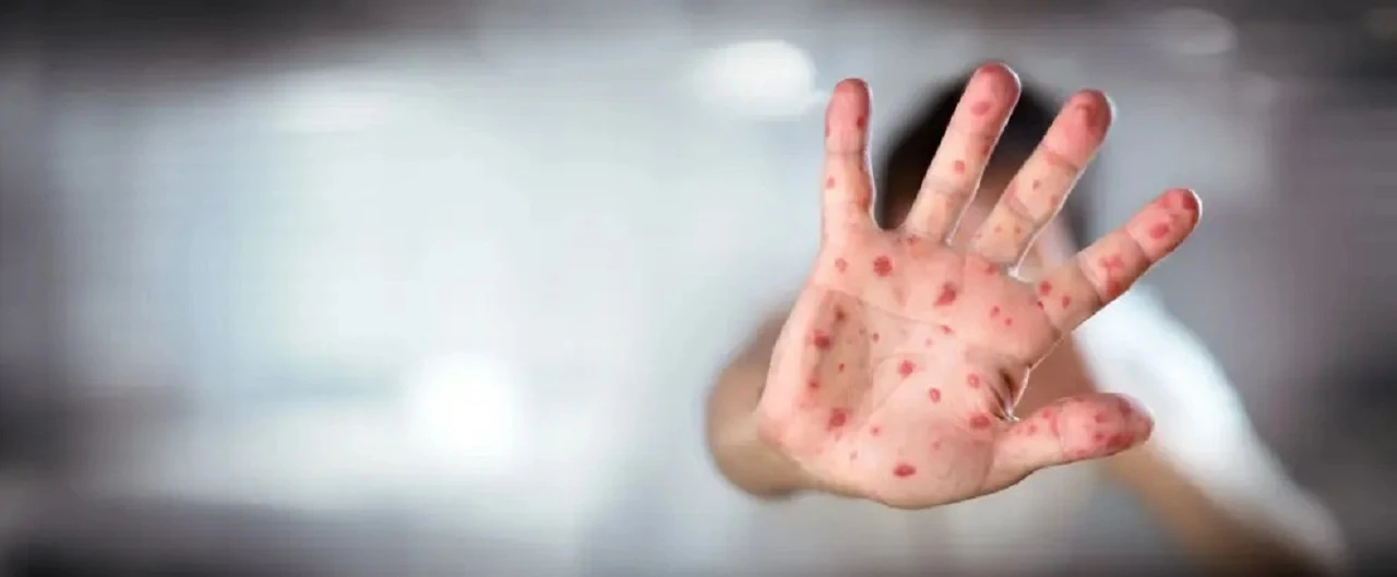 Kızamık salgını bir çocuğu daha hayattan kopardı