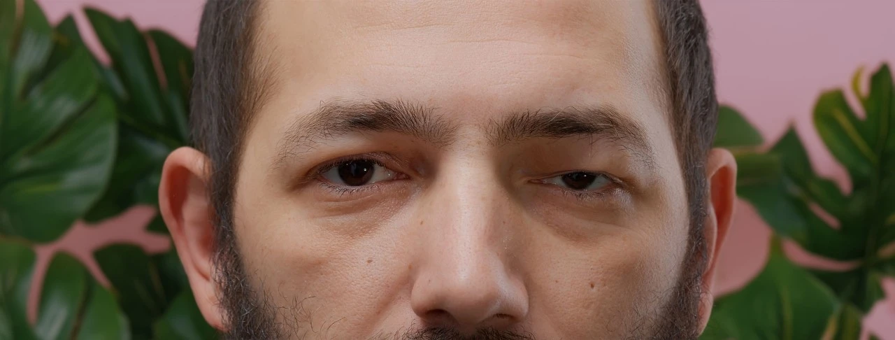 Göz kapağı sadece görünümü değil, görüş kalitesini de etkiliyor   