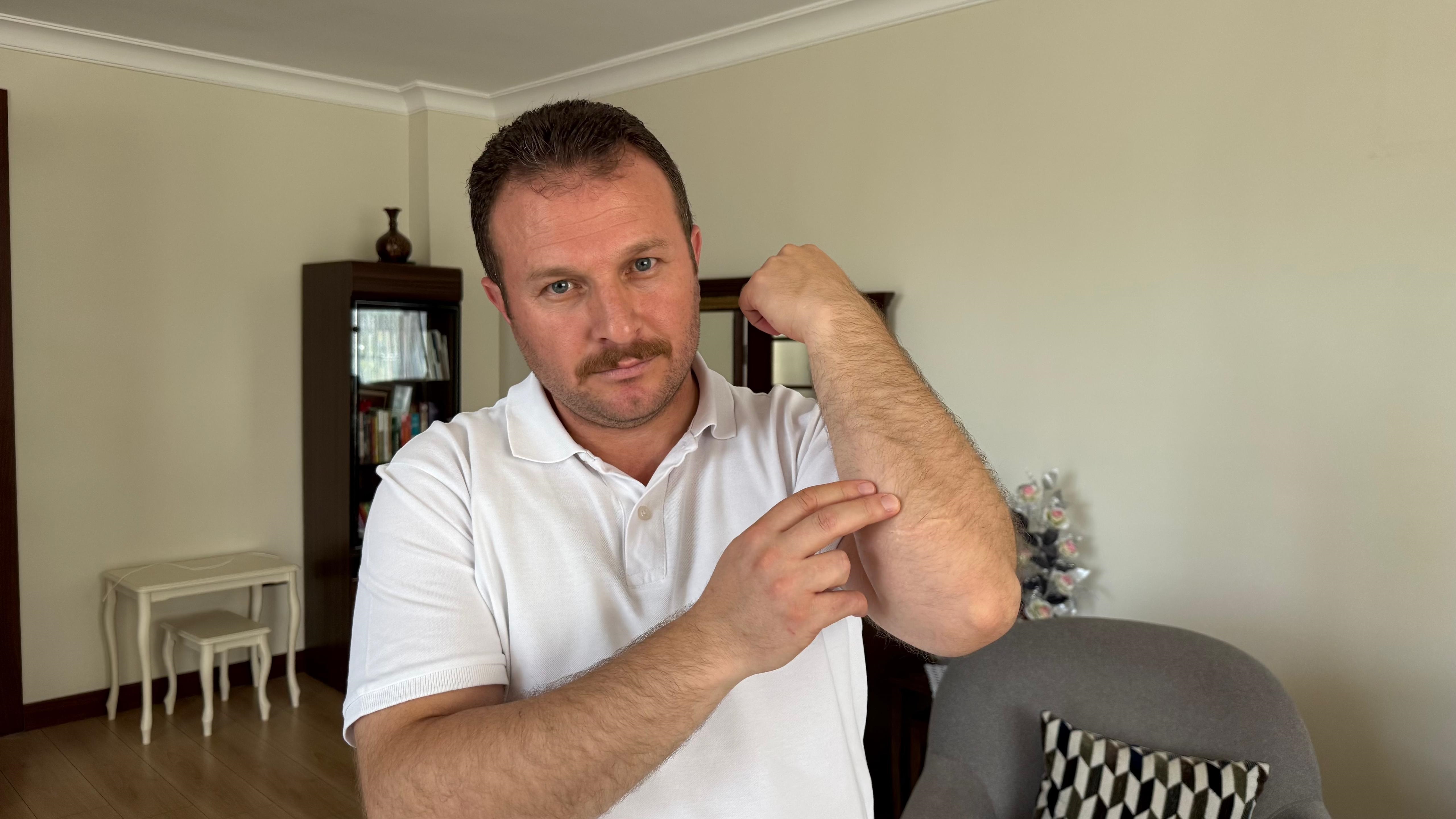 9 yıldır şarapnel parçalarıyla yaşıyor