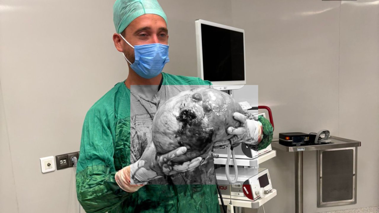 Karpuz Büyüklüğünde Kitle