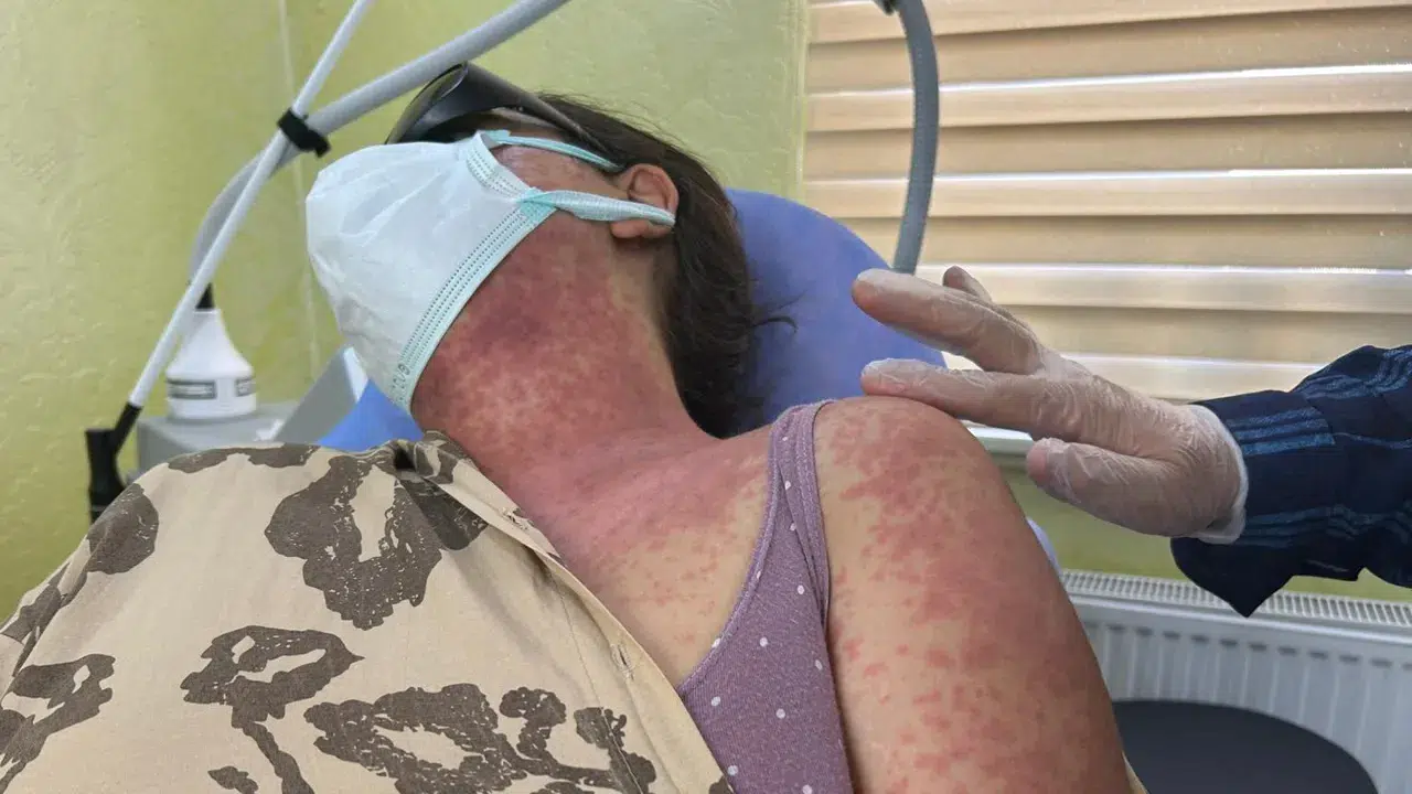 ‘Beyazlatıcı krem’ faciası: 4 kişi hastanelik oldu