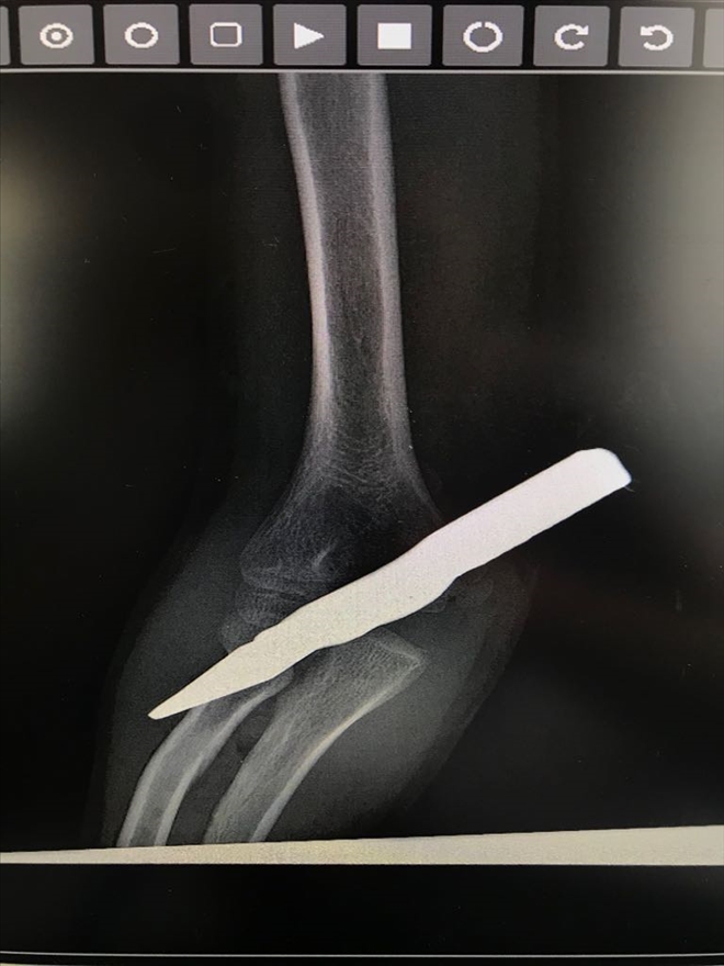 KOLUNA SAPLANAN DEMİRLE HASTANEYE KALDIRILDI