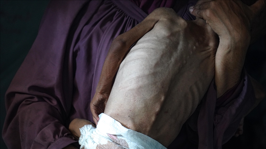 Gazze’de Açlık Her Geçen Gün Daha Fazla Can Alıyor