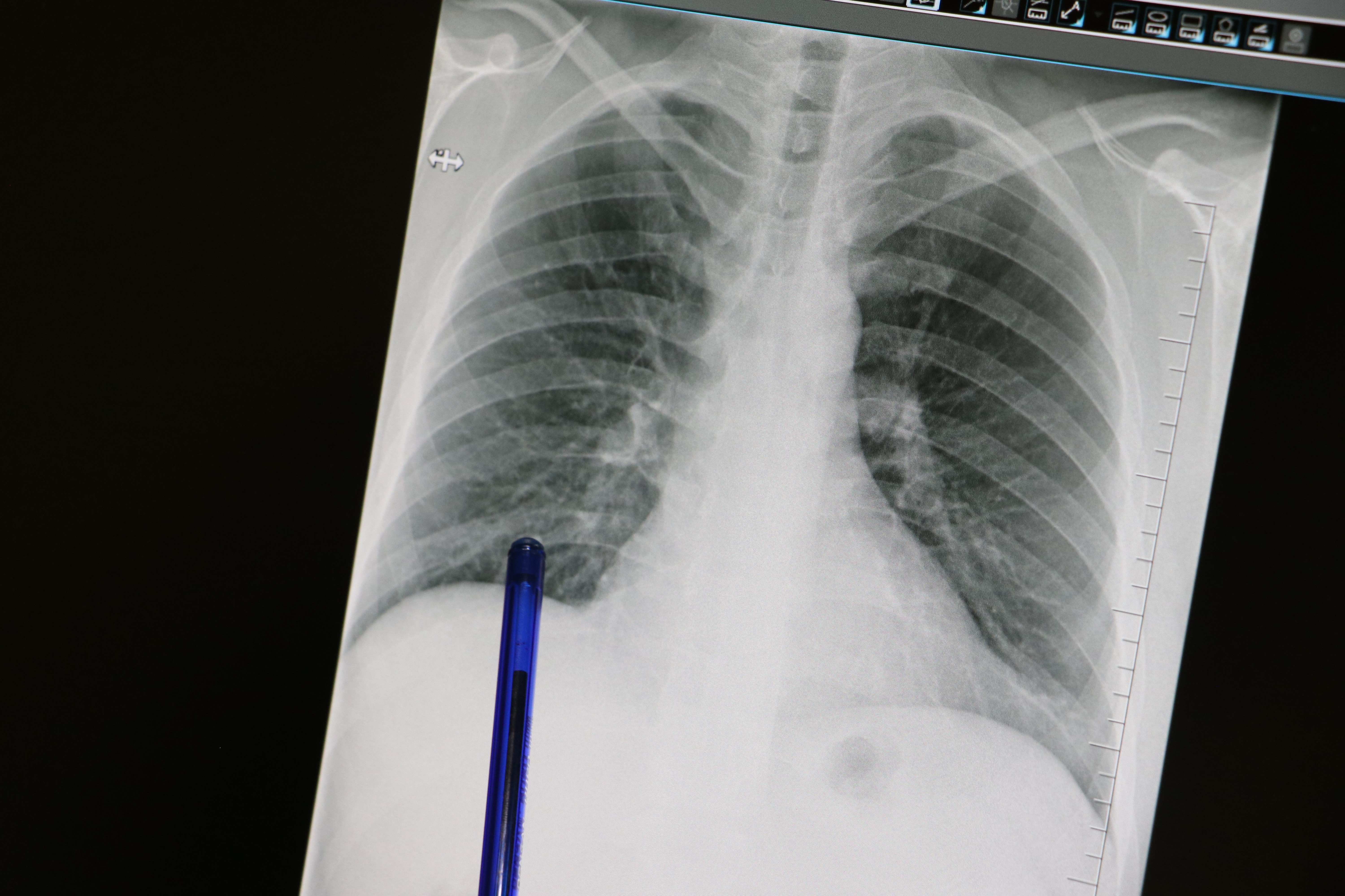 Sürekli Öksürük Hayati Tehlike Taşıyor