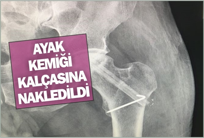 AYAK KEMİĞİ KALÇASINA NAKLEDİLDİ