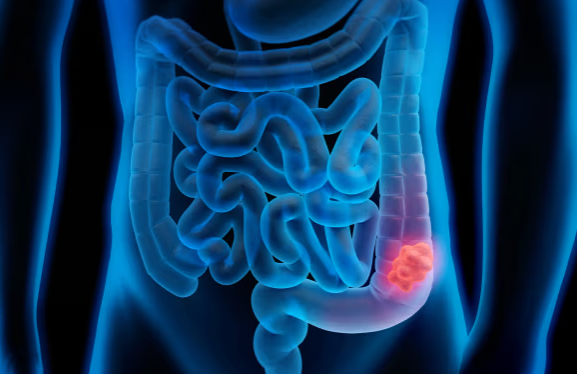 Kalın Bağırsak Kanserine Karşı Tarama Çağrısı