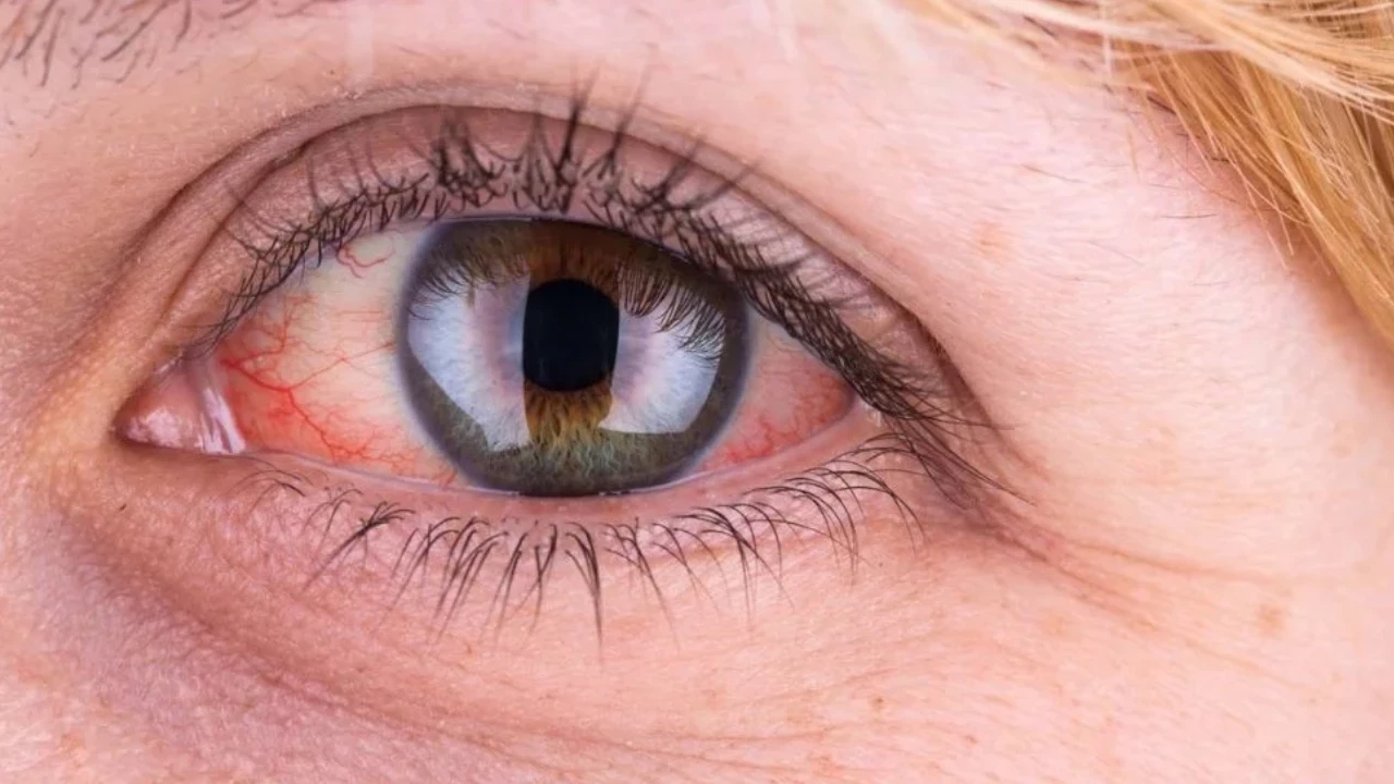 Sağlık Bakanlığı'ndan 'göz tansiyonu' açıklaması