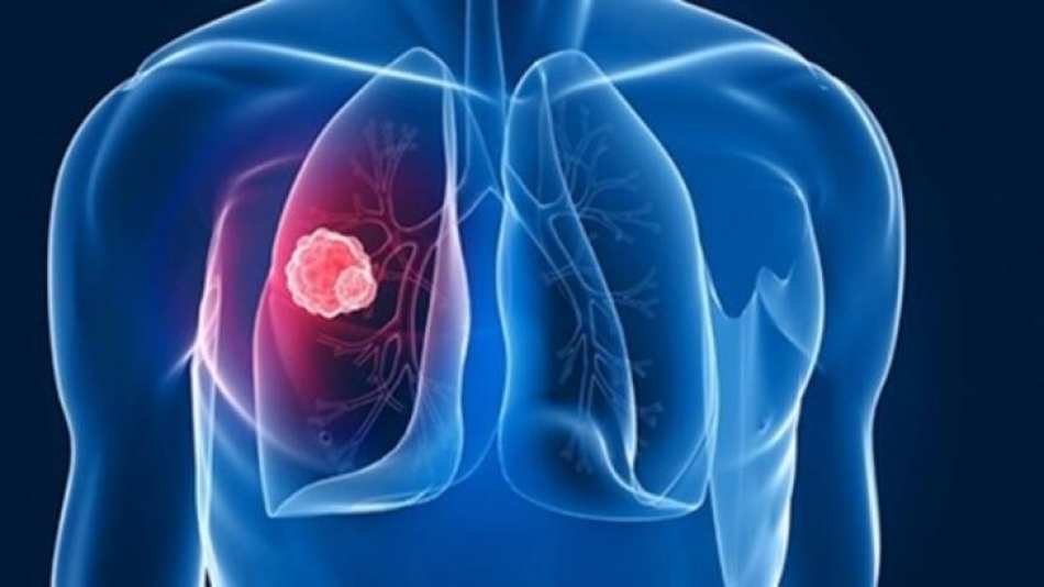 Tüberkülozda erken tanı hayat kurtarıyor