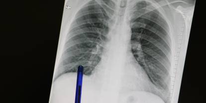 Sürekli Öksürük Hayati Tehlike Taşıyor