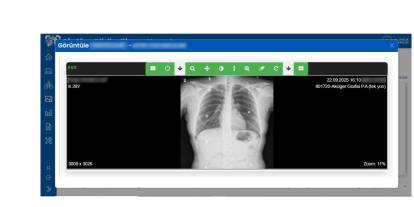 'Akciğer Görüntüleme Sistemi'ni hayata geçirdi