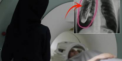 Hastaya "Göğsünde canlı böcek var" teşhisi konuldu, gerçek çok başka çıktı