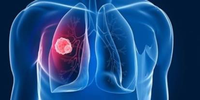 Tüberkülozda erken tanı hayat kurtarıyor