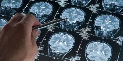 Derin uyku Alzheimer'a karşı koruma sağlayabilir